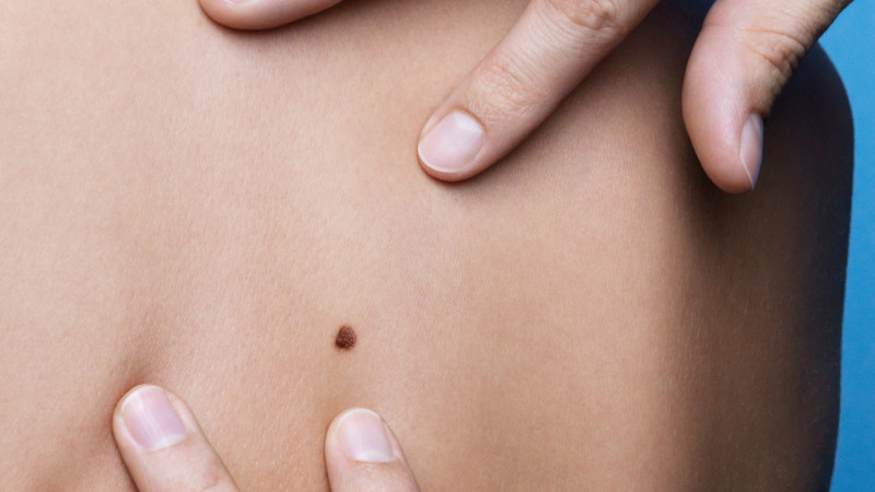 L’Oréal România lansează o campanie de prevenție și diagnosticare a cancerului de piele