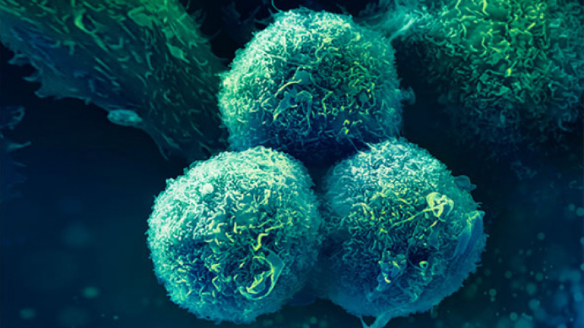 Diagnosticarea precoce a cancerului pulmonar și inițierea rapidă a tratamentului adecvat ar trebui să fie priorități la nivel de politici de sănătate în România