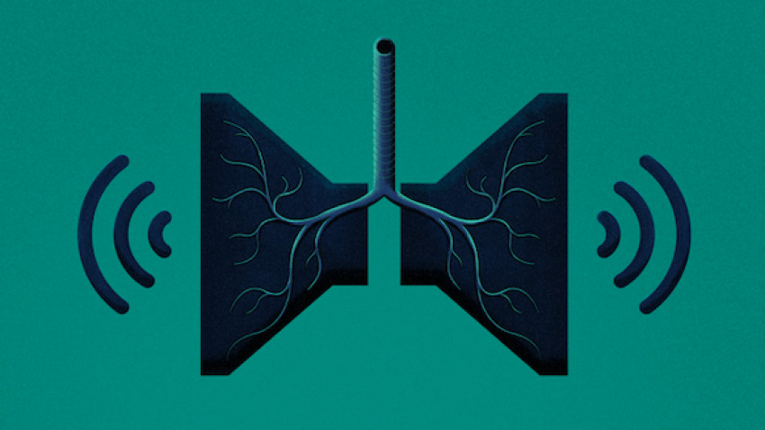 Cancerul pulmonar devine tot mai invizibil în contextul pandemiei de COVID-19- un număr semnificativ de cazuri rămân nediagnosticate